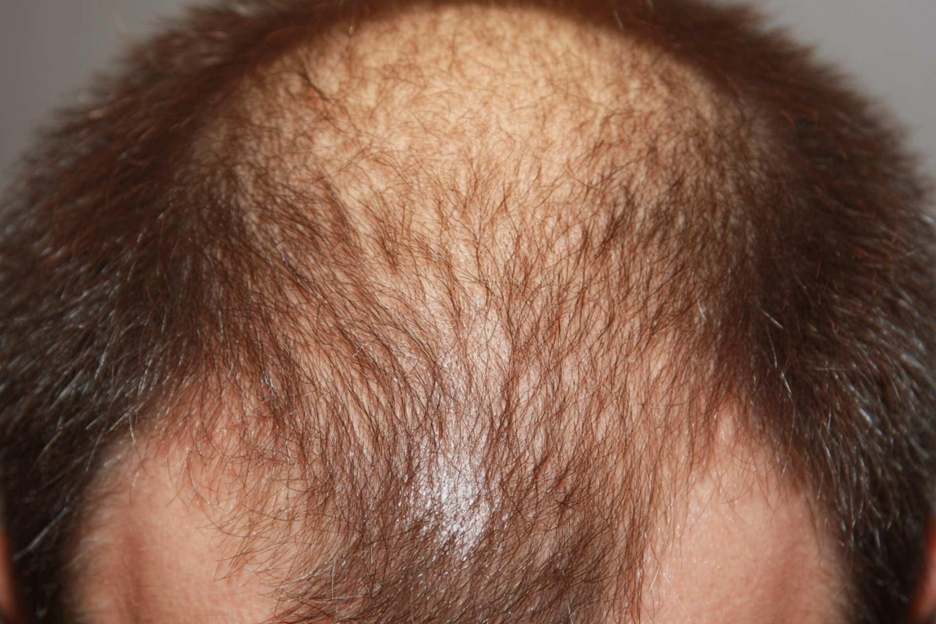 Haartherapie gegen Haarausfall​ im Aesthetic Centrum Bamberg